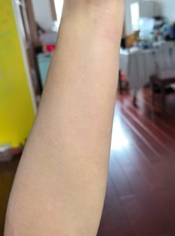 Arm After Treatment