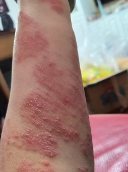 Arm Before Treatment