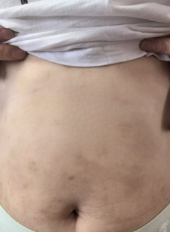 Body After Treatment
