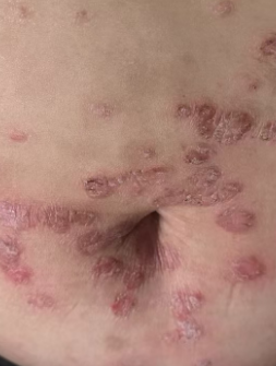 Body Before Treatment