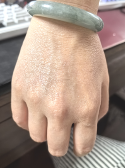 Hand After Treatment