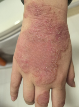 Hand Before Treatment