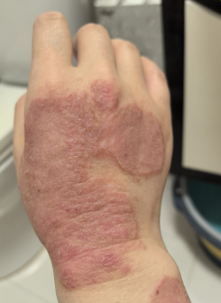 Second Hand After Treatment
