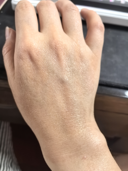Second Hand Before Treatment