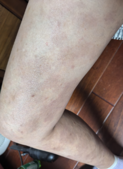 Leg After Treatment