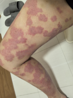 Leg Before Treatment