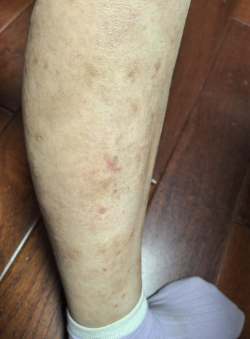 Second Leg After Treatment