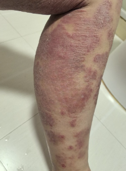 Second Leg Before Treatment