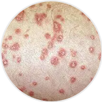 Guttate Psoriasis