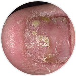 Nail Psoriasis