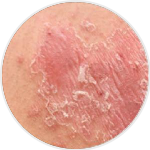 Psoriasis Vulgaris