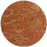 Pustular Psoriasis